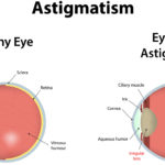 Optima Eyecare, Astigmatism